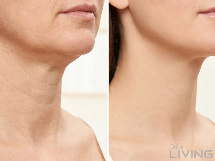 39% Off - Neck & Décolleté Sculpt BTL Offer