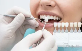 Buy 1 Get 1 - Tooth Veneer