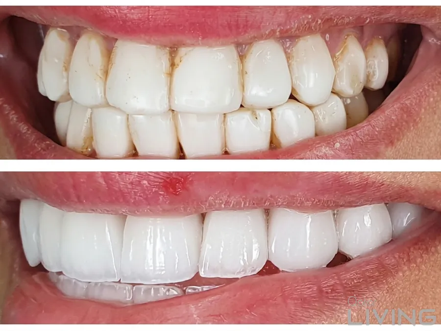 اشترِ قشرة سن واحصل على الثانية مجانًا