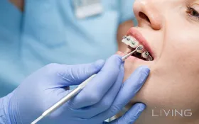 90% Off - Braces Installation Offer