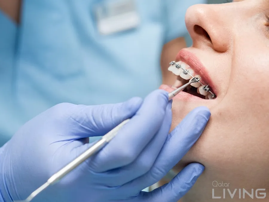 90% Off - Braces Installation Offer