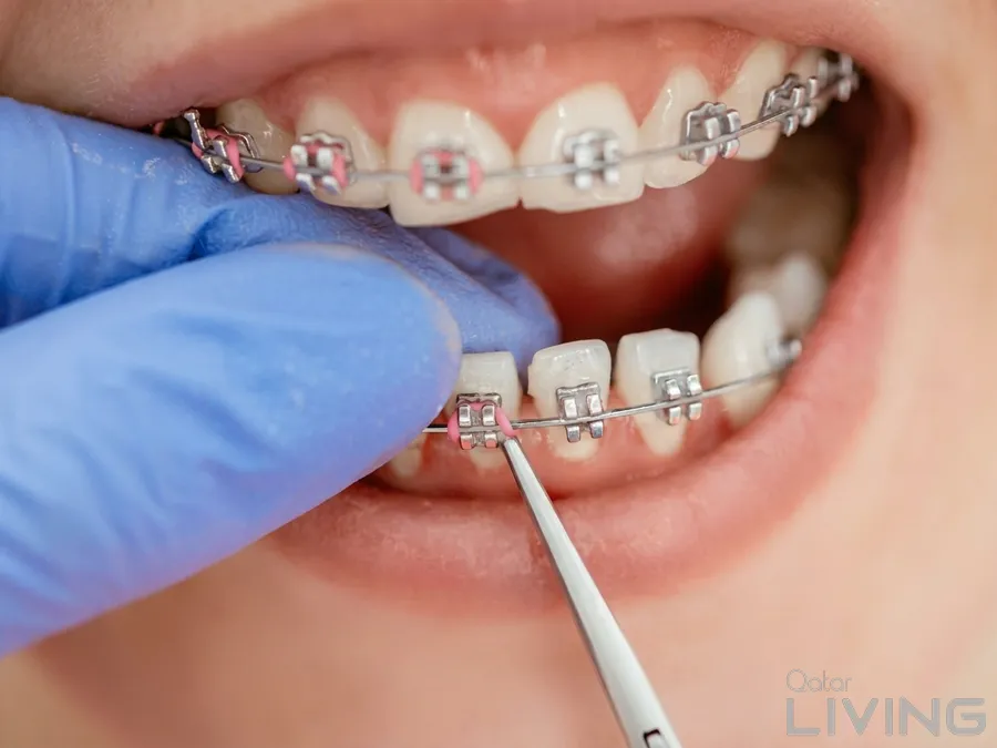 90% Off - Braces Installation Offer