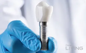 45% Off - Dental Implant Offer