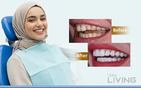 خصم 75% على ابتسامة هوليوود لكل سن