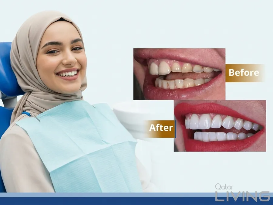خصم 75% على ابتسامة هوليوود لكل سن