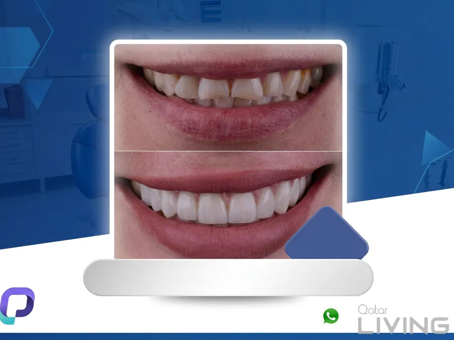 خصم 75% على ابتسامة هوليوود لكل سن