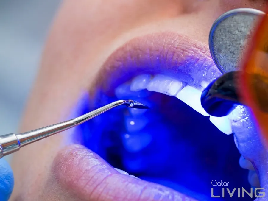 58% Off - Composite Filling