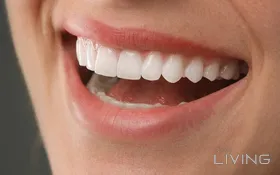 77% Off - Emax Veneers