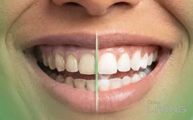 82% Off - Teeth Whitening, Scaling & Polishing