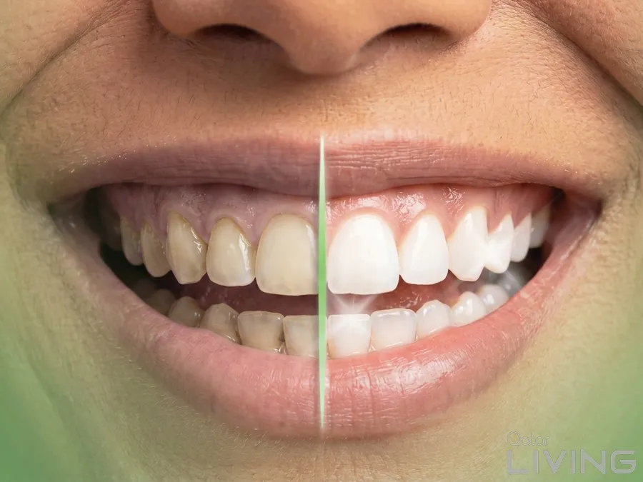 82% Off - Teeth Whitening, Scaling & Polishing