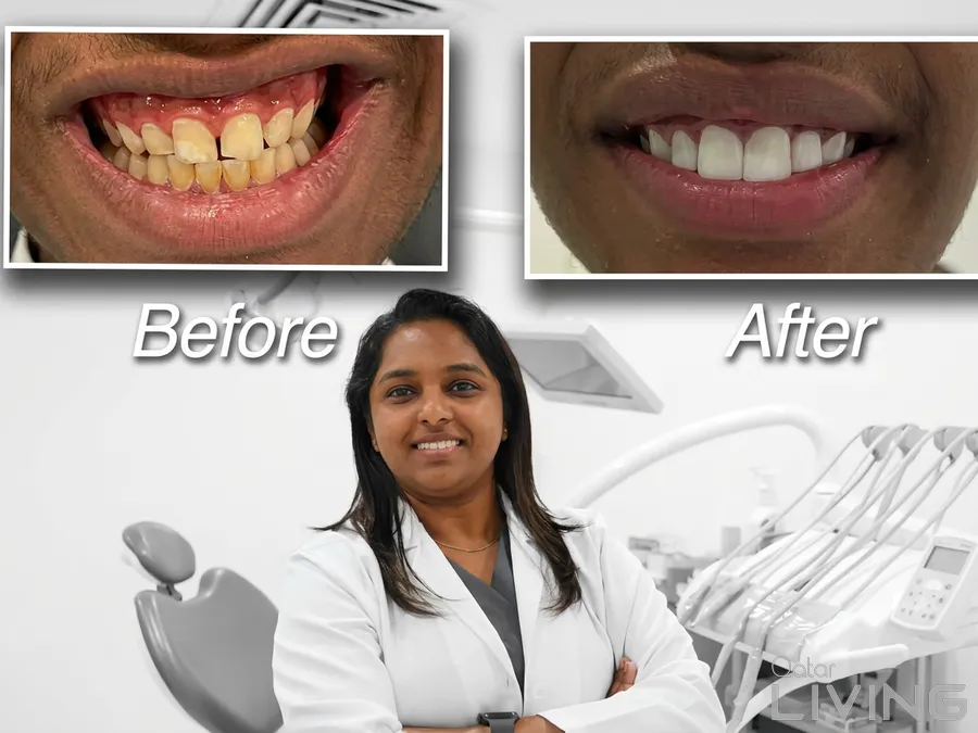 Flexible Denture (1-5 Teeth) - 1199 QAR