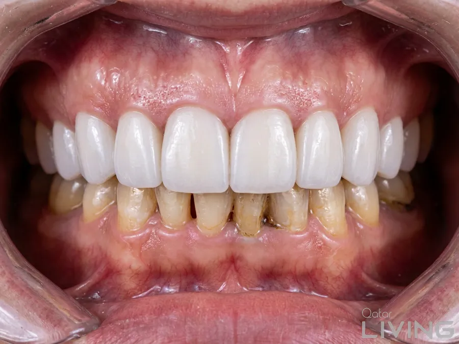 80% Off – Composite Veneer (20 Teeth)