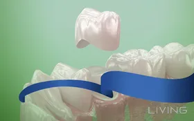 Zirconium Crown (Per Tooth) - 849 QAR